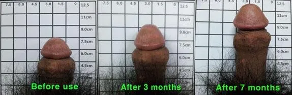 Kinkstasy Male Sex Toys Size Doctor Patented Penis Vacuum Extender